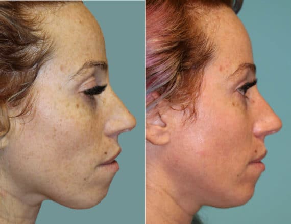 Before and after Laser Treatments by Dr. Shervin Naderi, Patient 12514