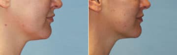 Before and after Ulthera by Dr. Shervin Naderi, Patient 12576