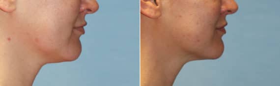 Ulthera before and after photos in Chevy Chase, MDUlthera Before and After Photos in Chevy Chase, MD