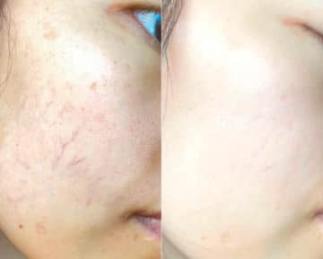 Before and after Laser Treatments by Dr. Shervin Naderi, Patient 17758