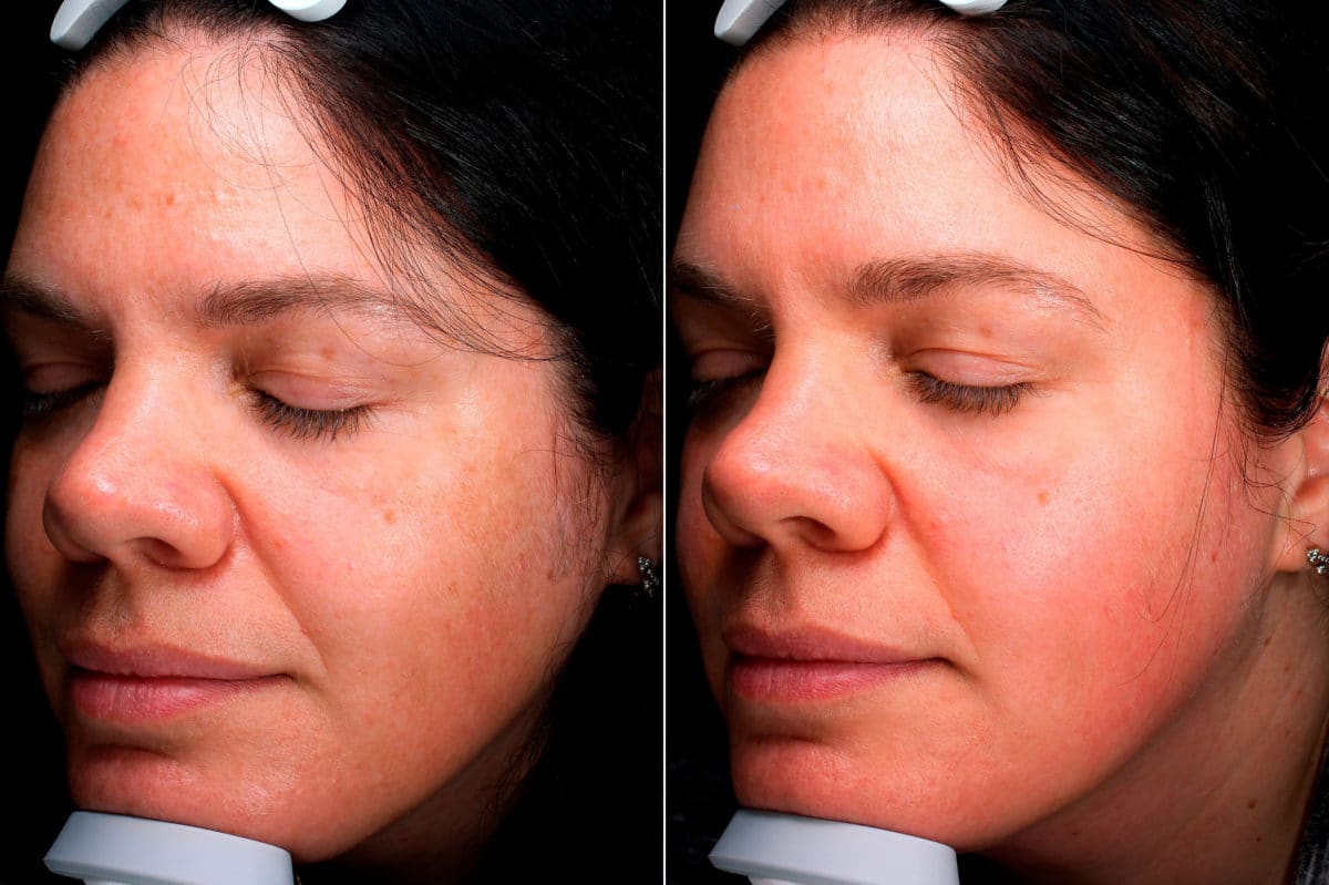 Before and after Chemical Peels by Dr. Shervin Naderi, Patient 19192