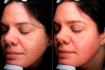 Before and after Chemical Peels by Dr. Shervin Naderi, Patient 19192