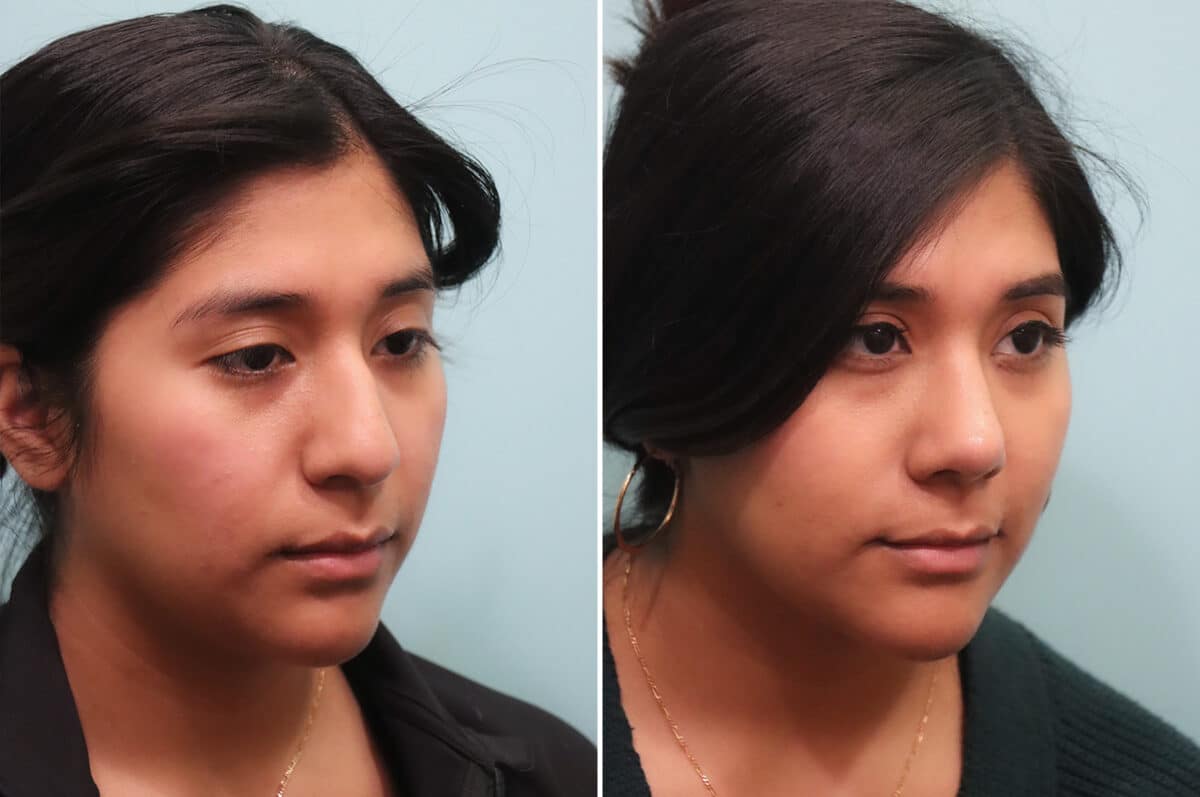 Before and after Rhinoplasty by Dr. Shervin Naderi, Patient 25035