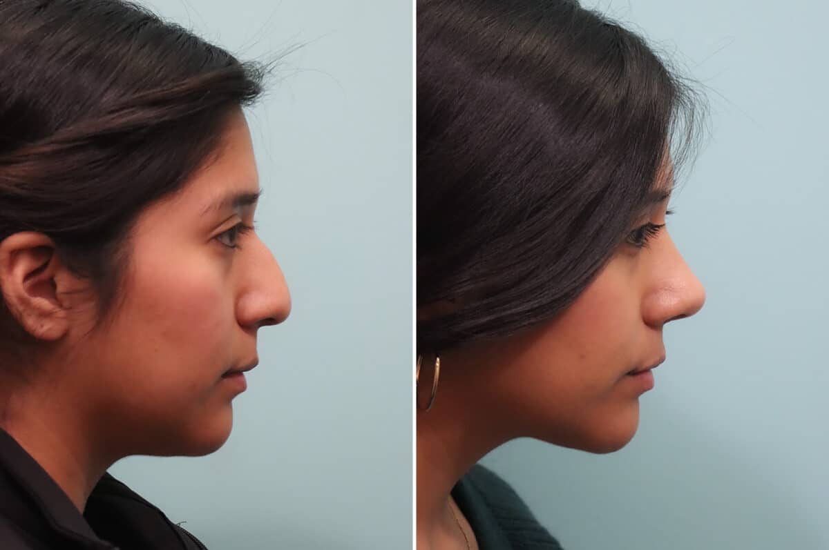 Before and after Rhinoplasty by Dr. Shervin Naderi, Patient 25035