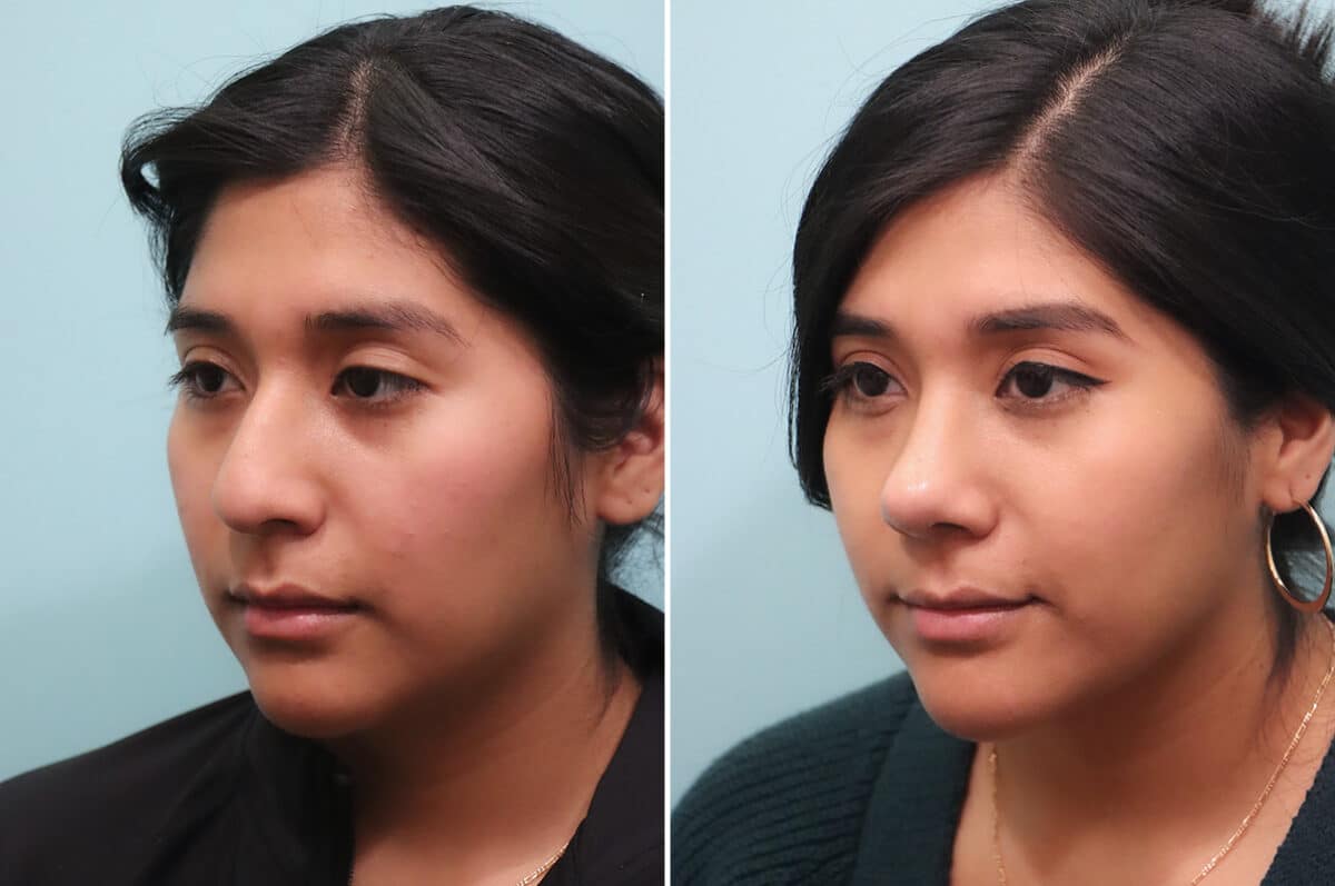 Before and after Rhinoplasty by Dr. Shervin Naderi, Patient 25035