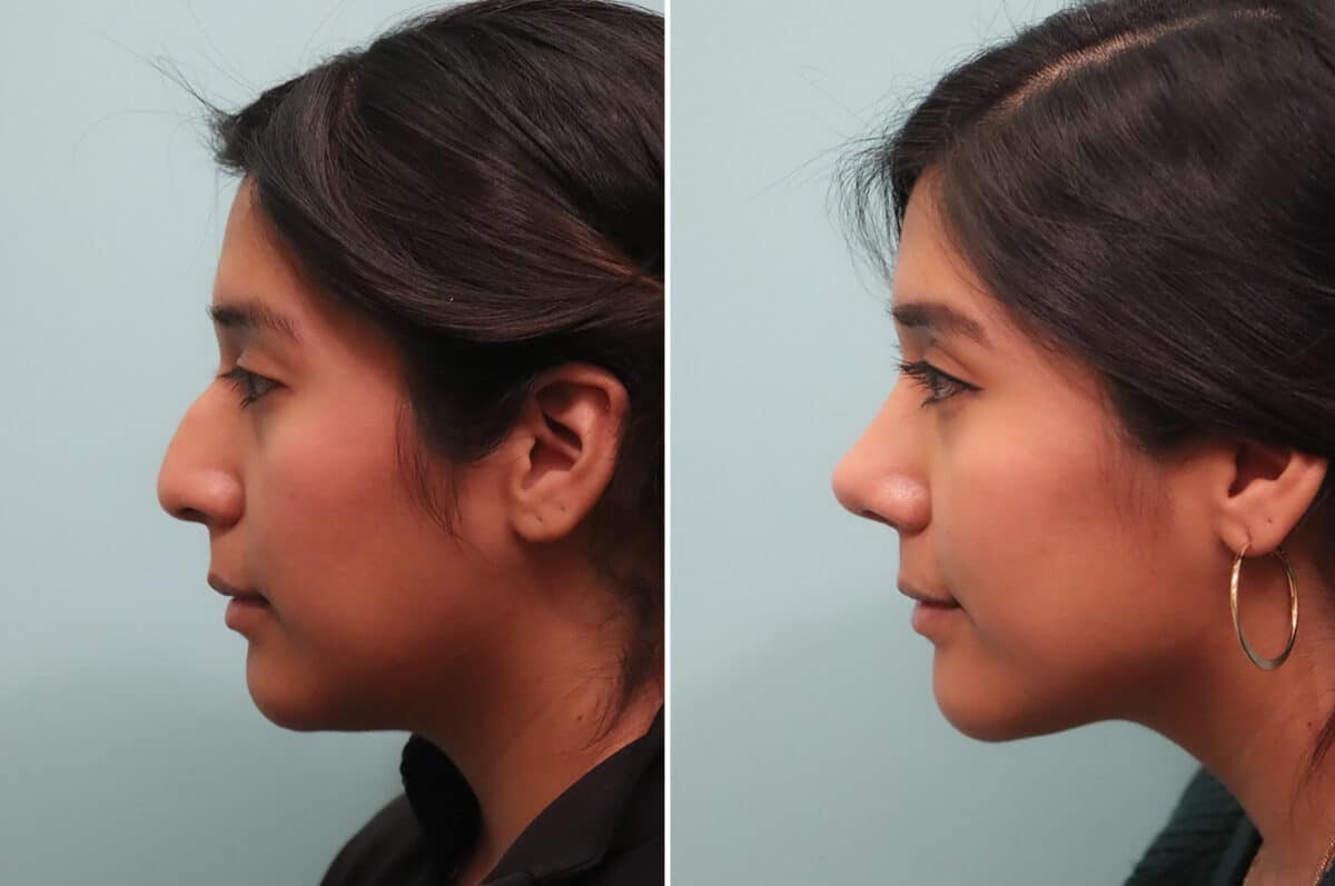 Before and after Rhinoplasty by Dr. Shervin Naderi, Patient 25035