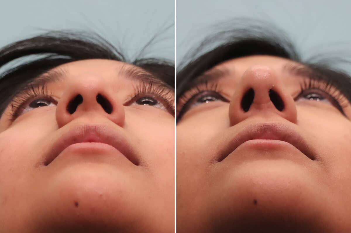 Before and after Rhinoplasty by Dr. Shervin Naderi, Patient 25035