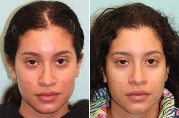 Before and after Laser Treatments by Dr. Shervin Naderi, Patient 25059