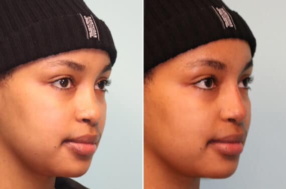 Before and after Non-Surgical Rhinoplasty by Dr. Shervin Naderi, Patient 25069