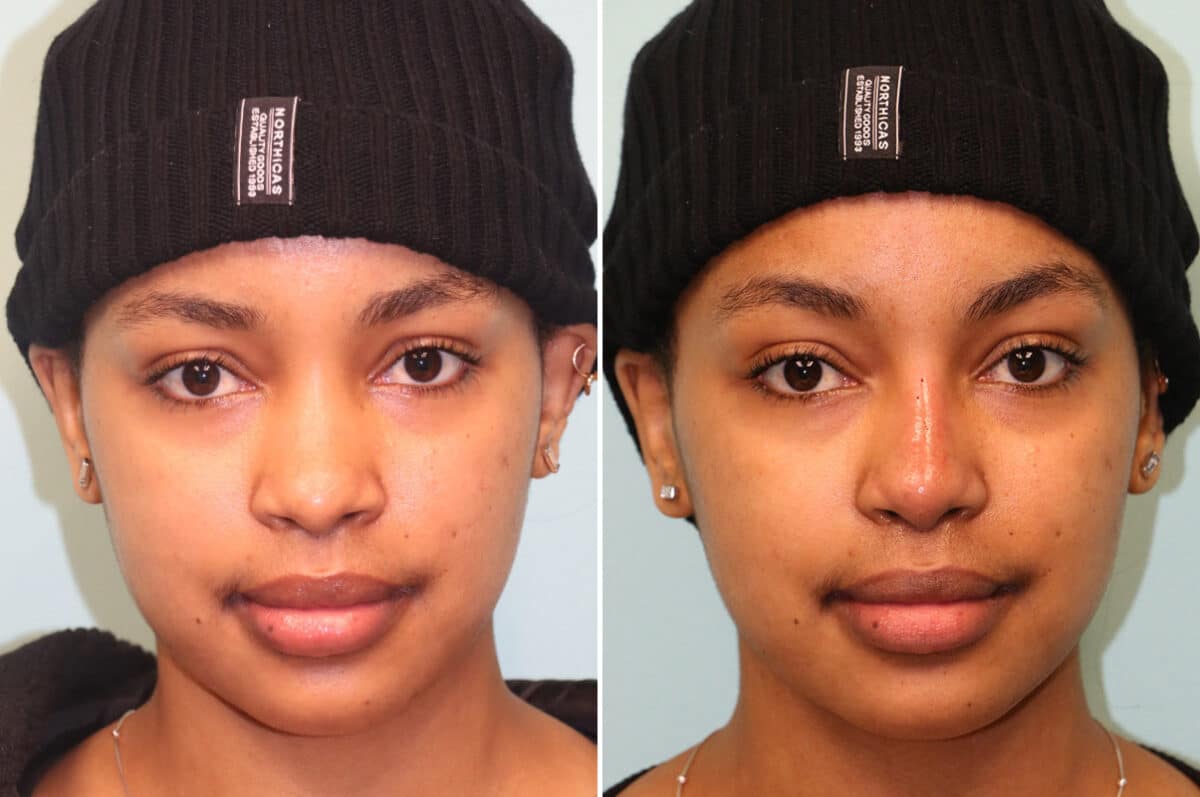 Before and after Non-Surgical Rhinoplasty by Dr. Shervin Naderi, Patient 25069