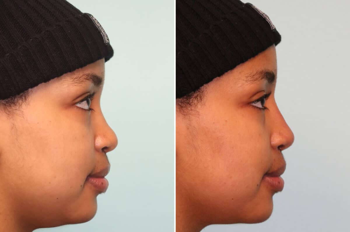 Before and after Non-Surgical Rhinoplasty by Dr. Shervin Naderi, Patient 25069