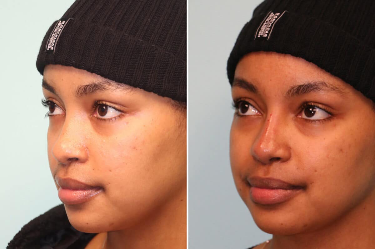 Before and after Non-Surgical Rhinoplasty by Dr. Shervin Naderi, Patient 25069