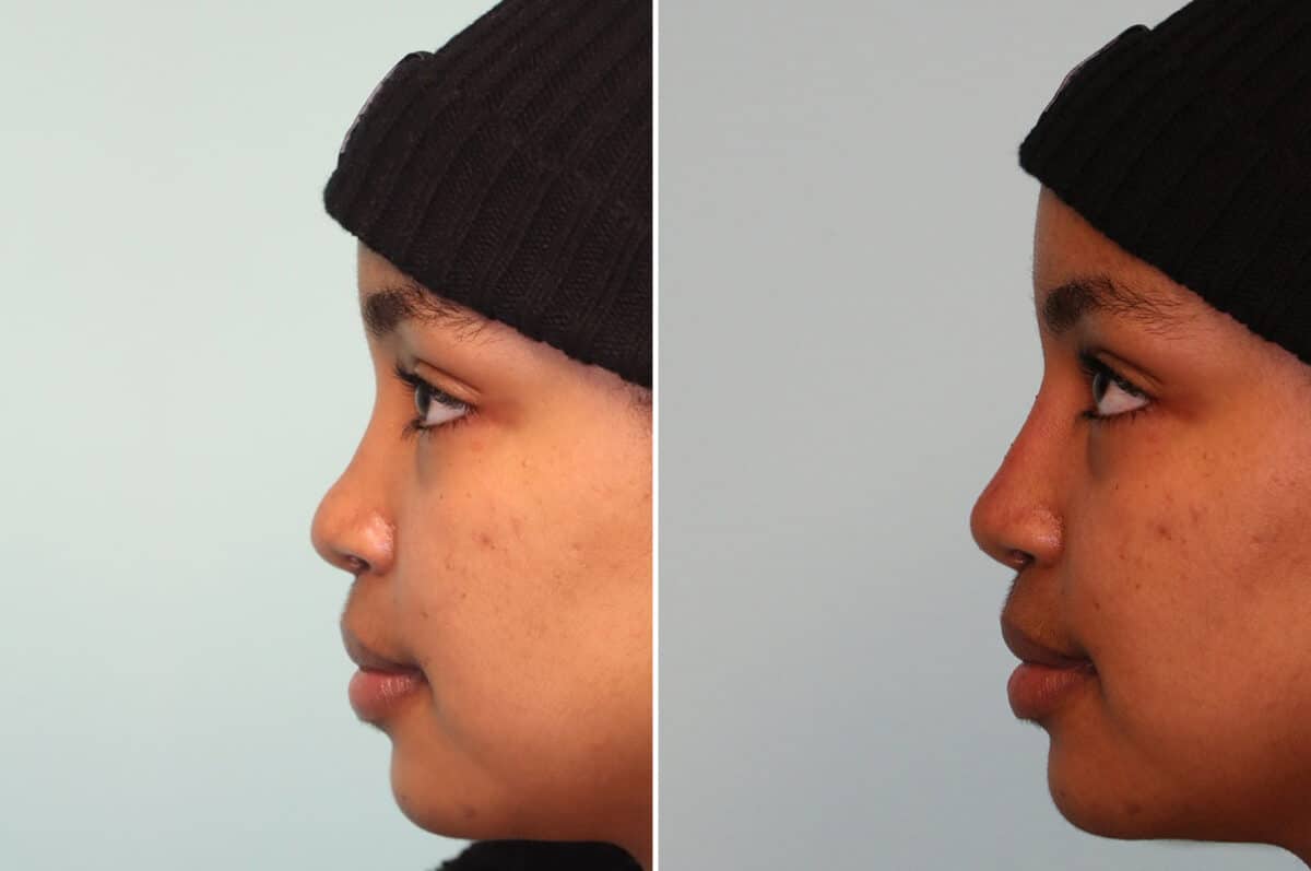 Before and after Non-Surgical Rhinoplasty by Dr. Shervin Naderi, Patient 25069