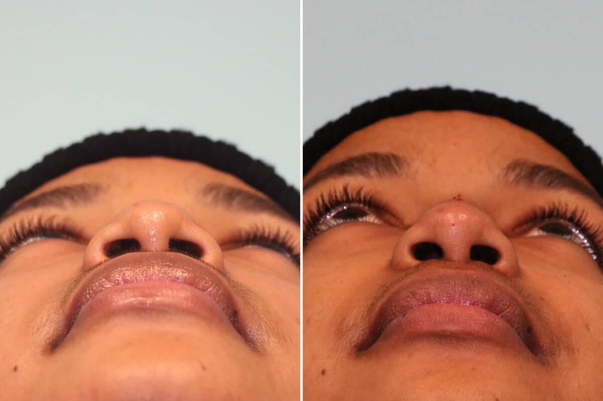 Before and after Non-Surgical Rhinoplasty by Dr. Shervin Naderi, Patient 25069