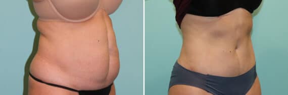 Before and after Tummy Tuck by Dr. Shervin Naderi, Patient 25088