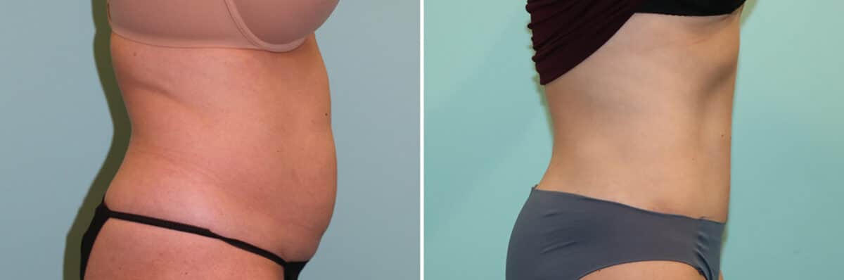 Before and after Tummy Tuck by Dr. Shervin Naderi, Patient 25088