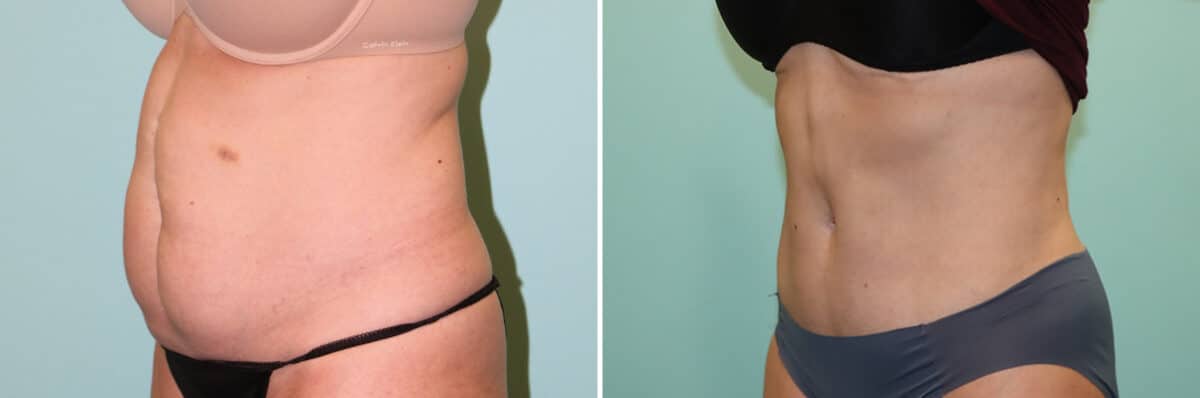 Before and after Tummy Tuck by Dr. Shervin Naderi, Patient 25088