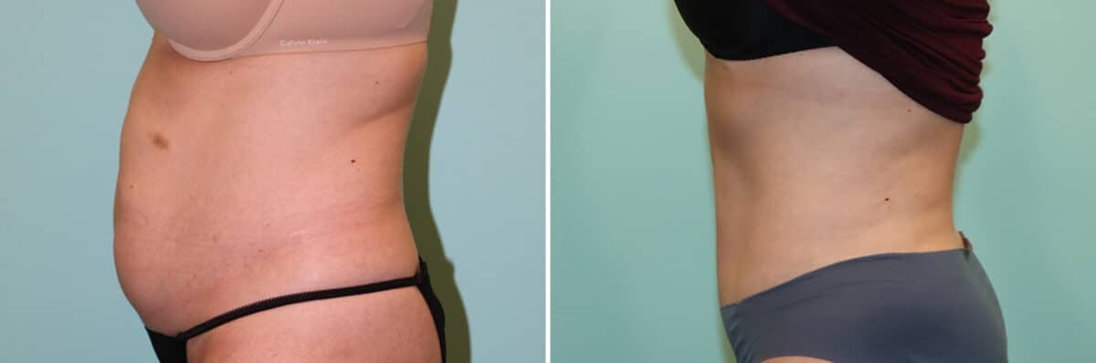 Before and after Tummy Tuck by Dr. Shervin Naderi, Patient 25088