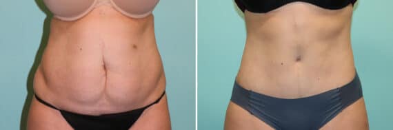 Before and after Tummy Tuck by Dr. Shervin Naderi, Patient 25088