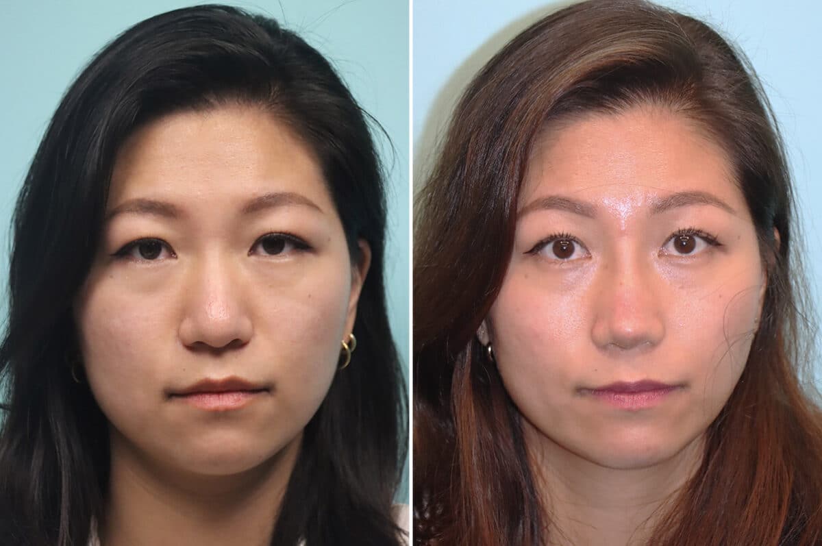 Before and after Rhinoplasty by Dr. Shervin Naderi, Patient 25104