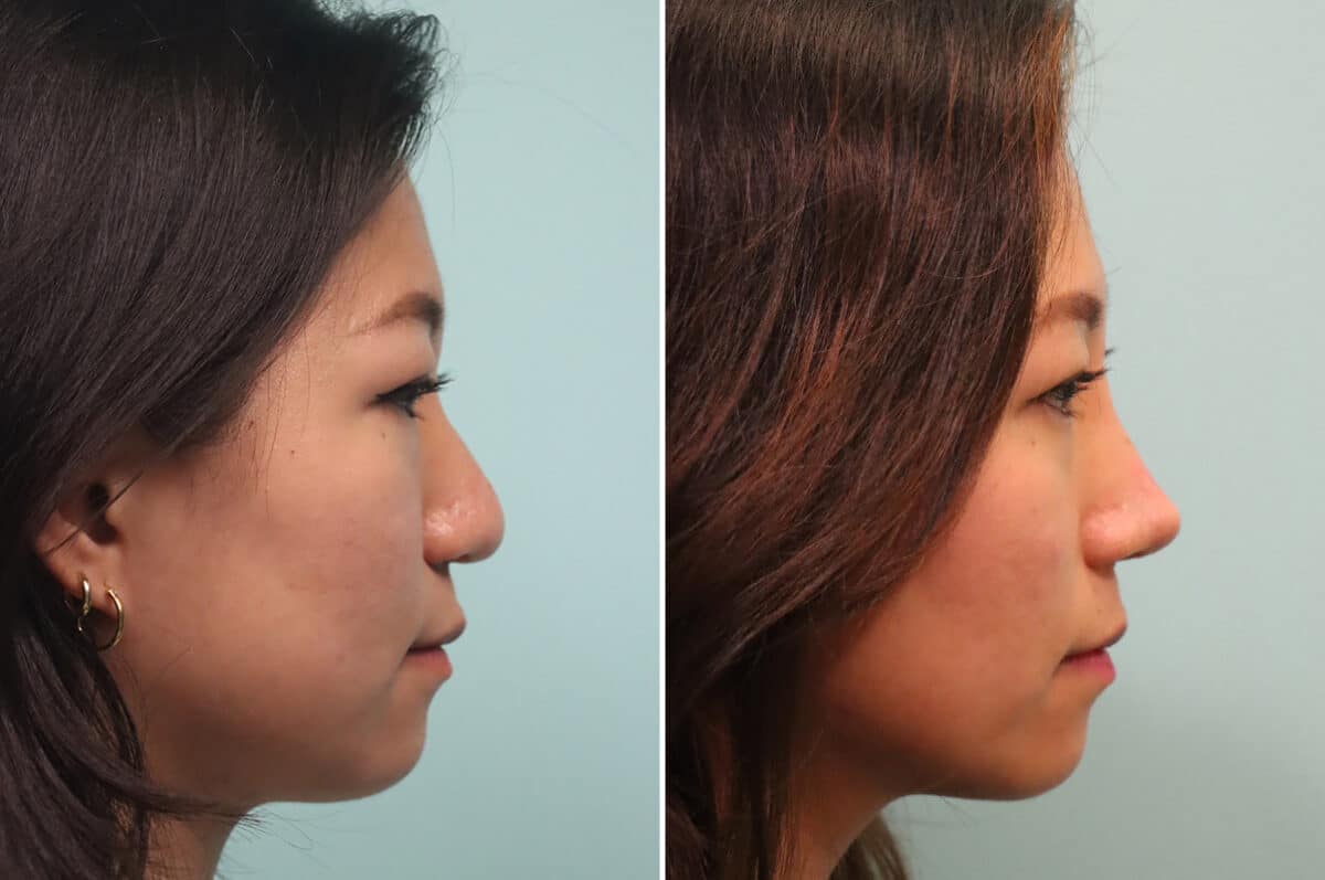 Before and after Rhinoplasty by Dr. Shervin Naderi, Patient 25104