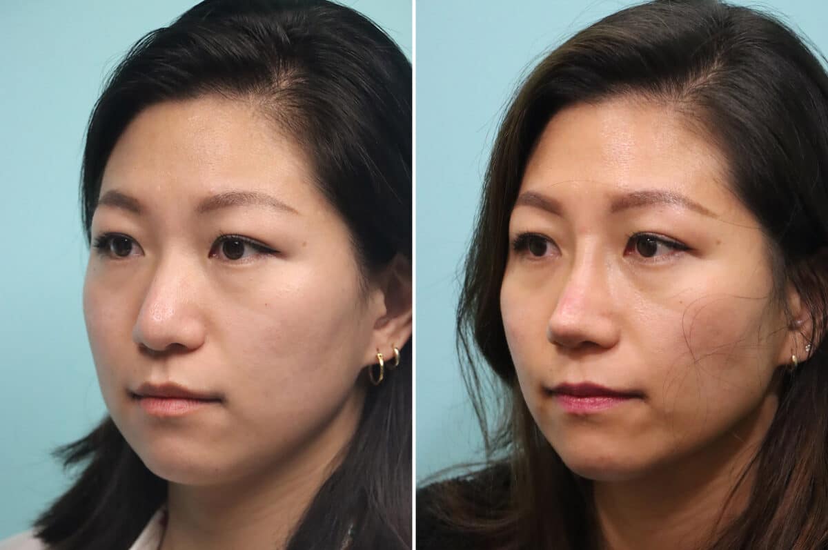 Before and after Rhinoplasty by Dr. Shervin Naderi, Patient 25104