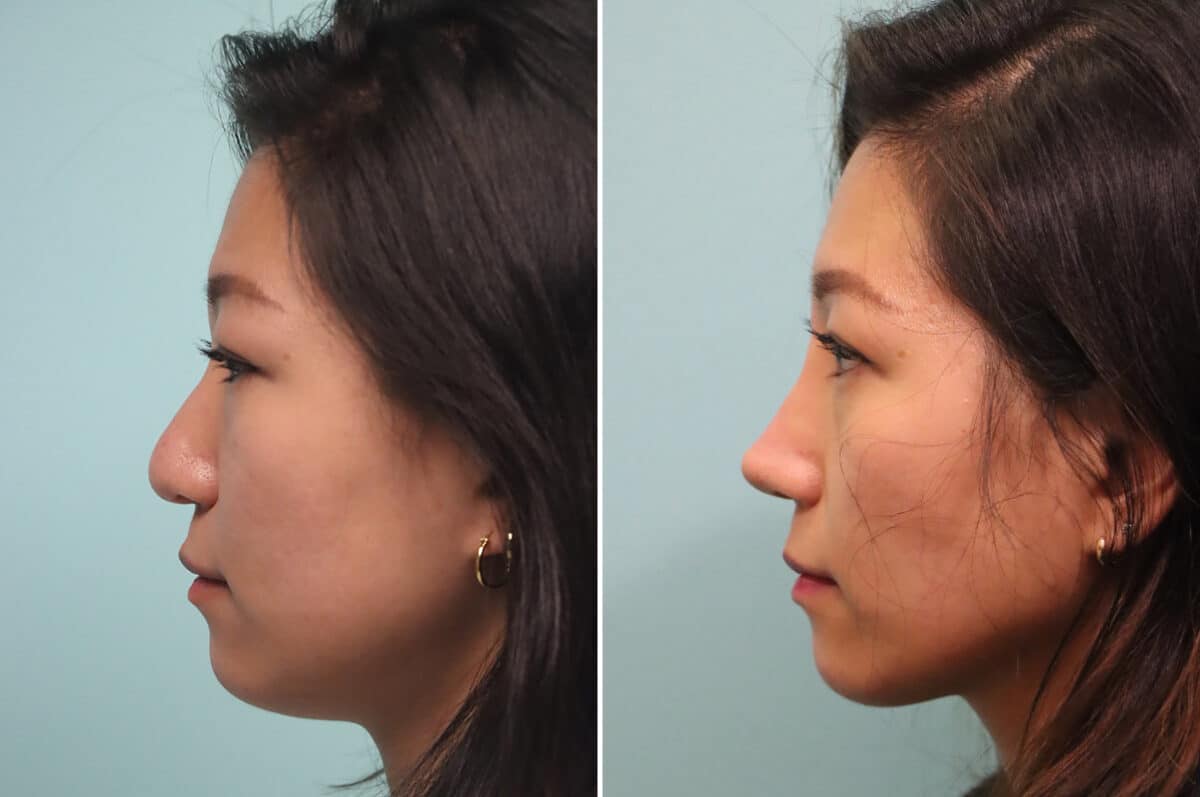 Before and after Rhinoplasty by Dr. Shervin Naderi, Patient 25104