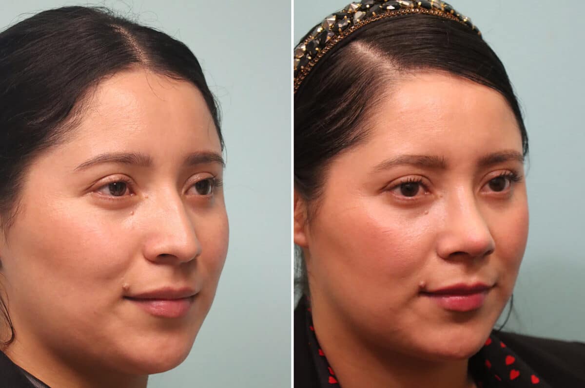 Before and after Rhinoplasty by Dr. Shervin Naderi, Patient 25120