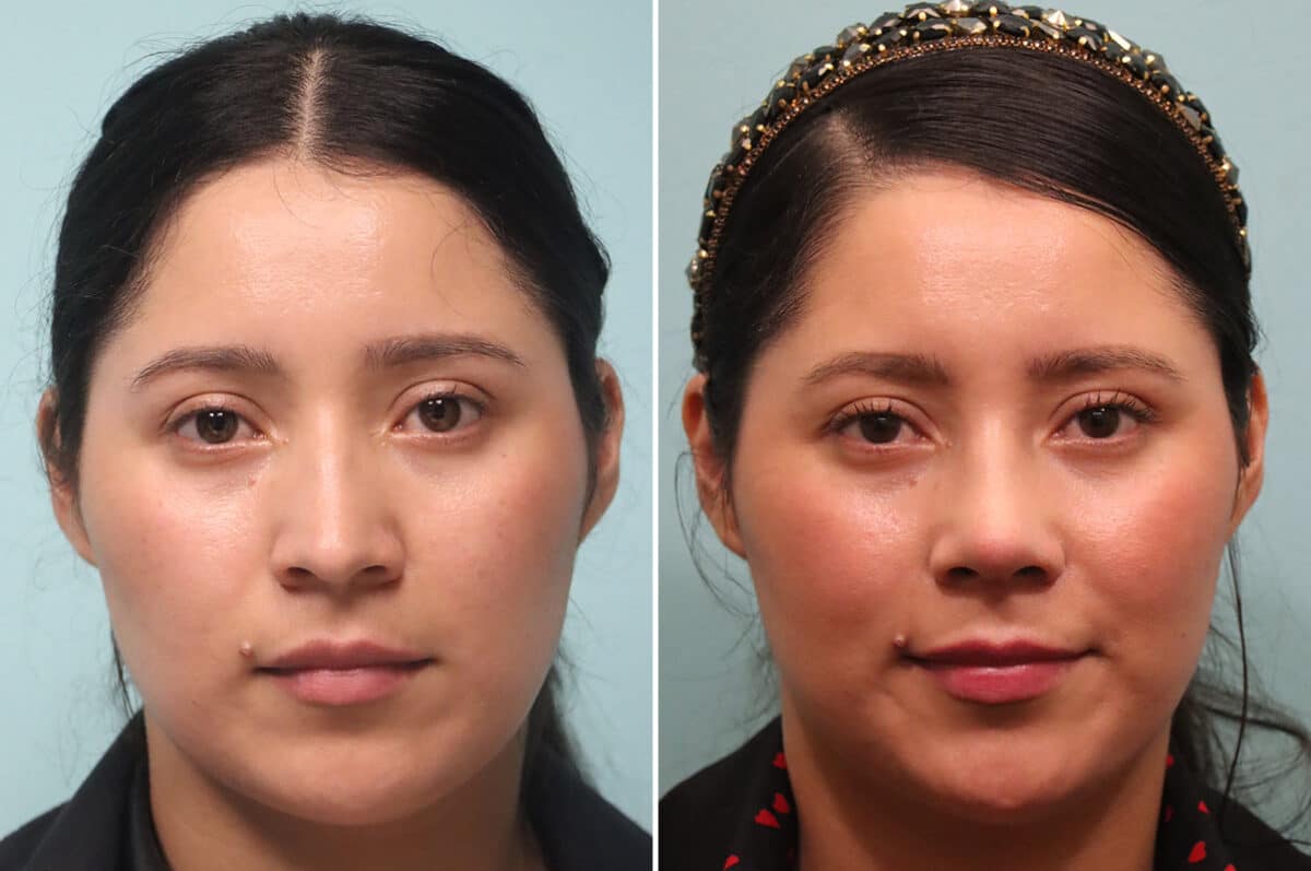 Before and after Rhinoplasty by Dr. Shervin Naderi, Patient 25120