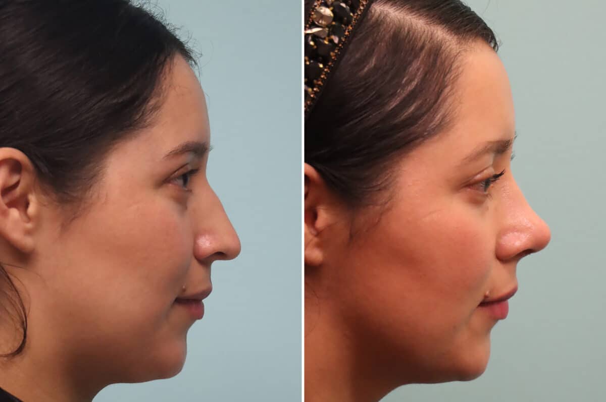 Before and after Rhinoplasty by Dr. Shervin Naderi, Patient 25120