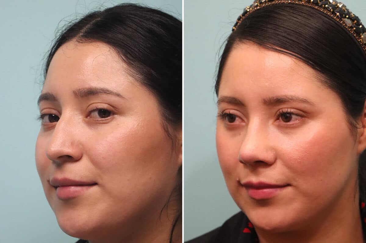 Before and after Rhinoplasty by Dr. Shervin Naderi, Patient 25120