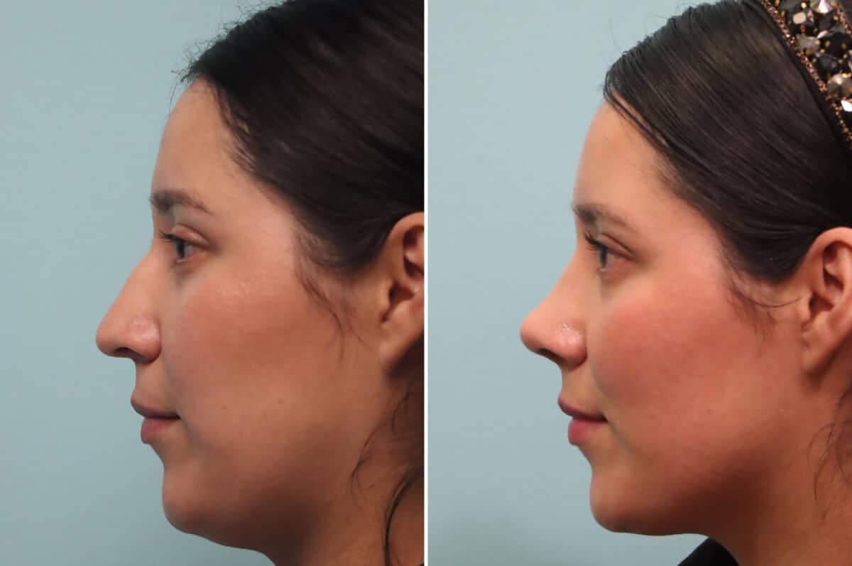 Before and after Rhinoplasty by Dr. Shervin Naderi, Patient 25120