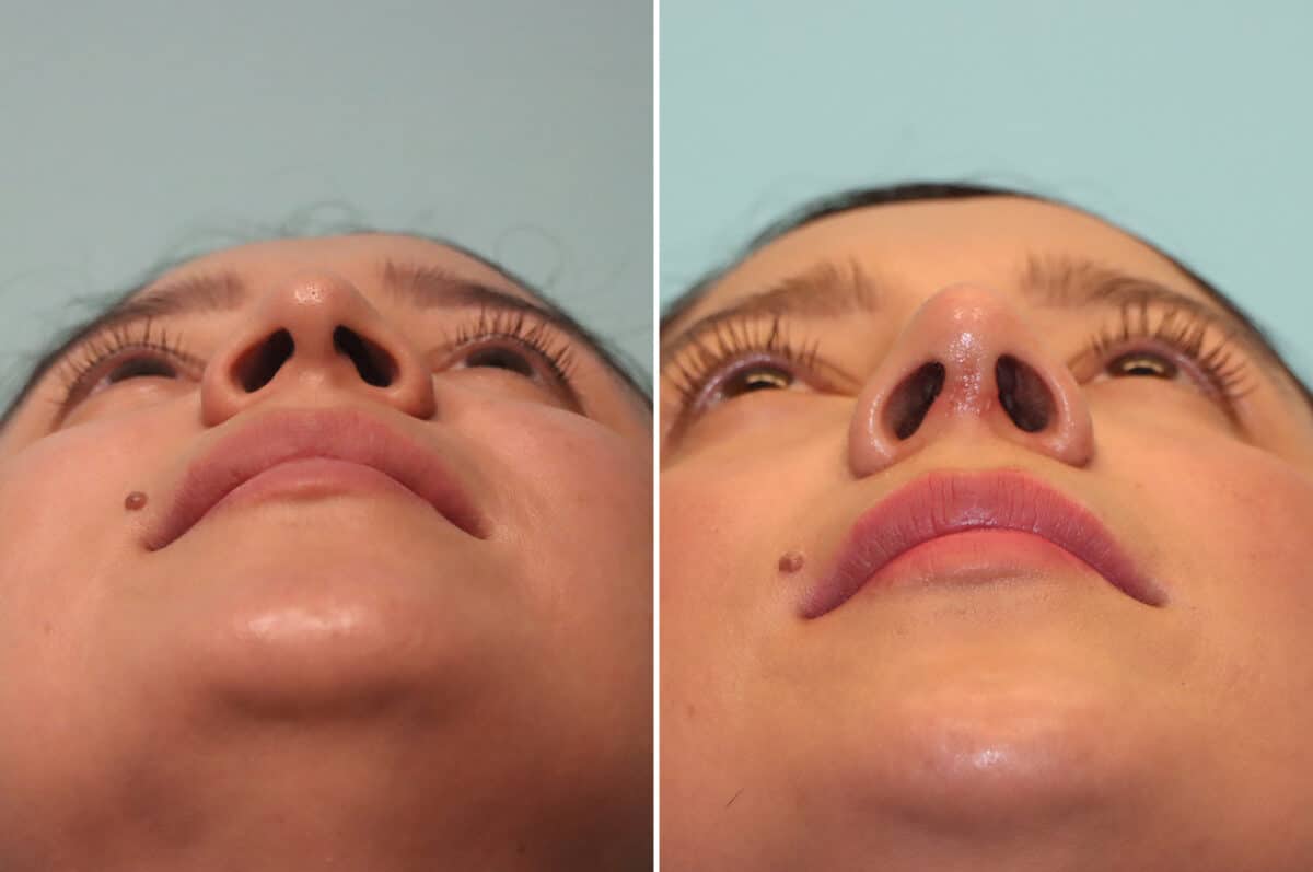 Before and after Rhinoplasty by Dr. Shervin Naderi, Patient 25120