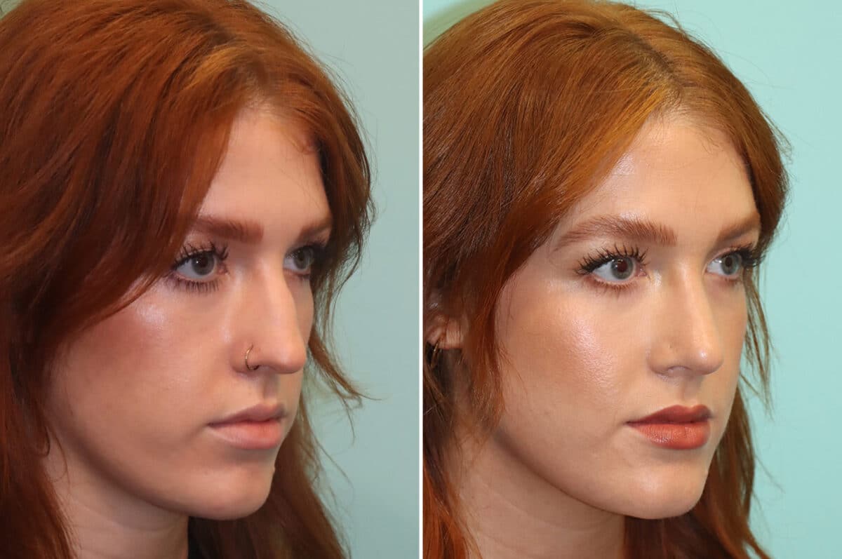 Before and after Rhinoplasty by Dr. Shervin Naderi, Patient 25190