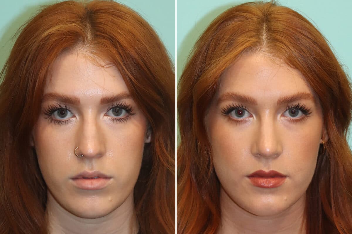 Before and after Rhinoplasty by Dr. Shervin Naderi, Patient 25190