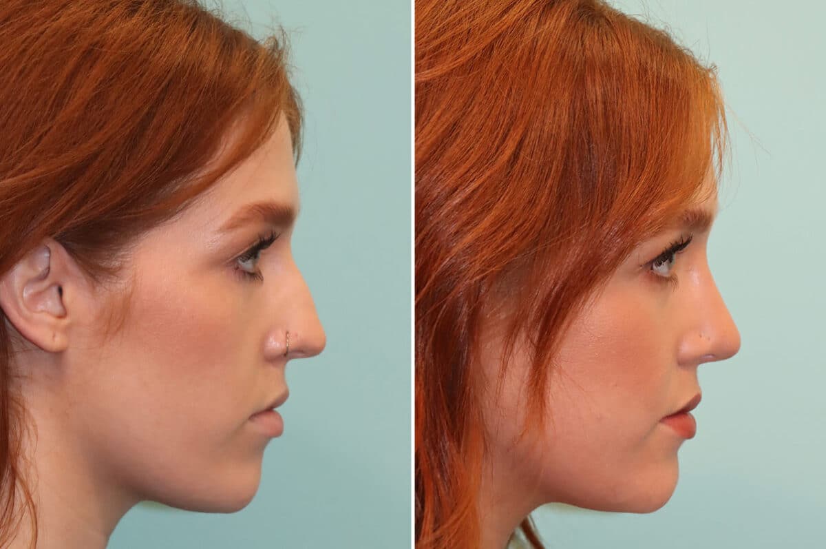 Before and after Rhinoplasty by Dr. Shervin Naderi, Patient 25190