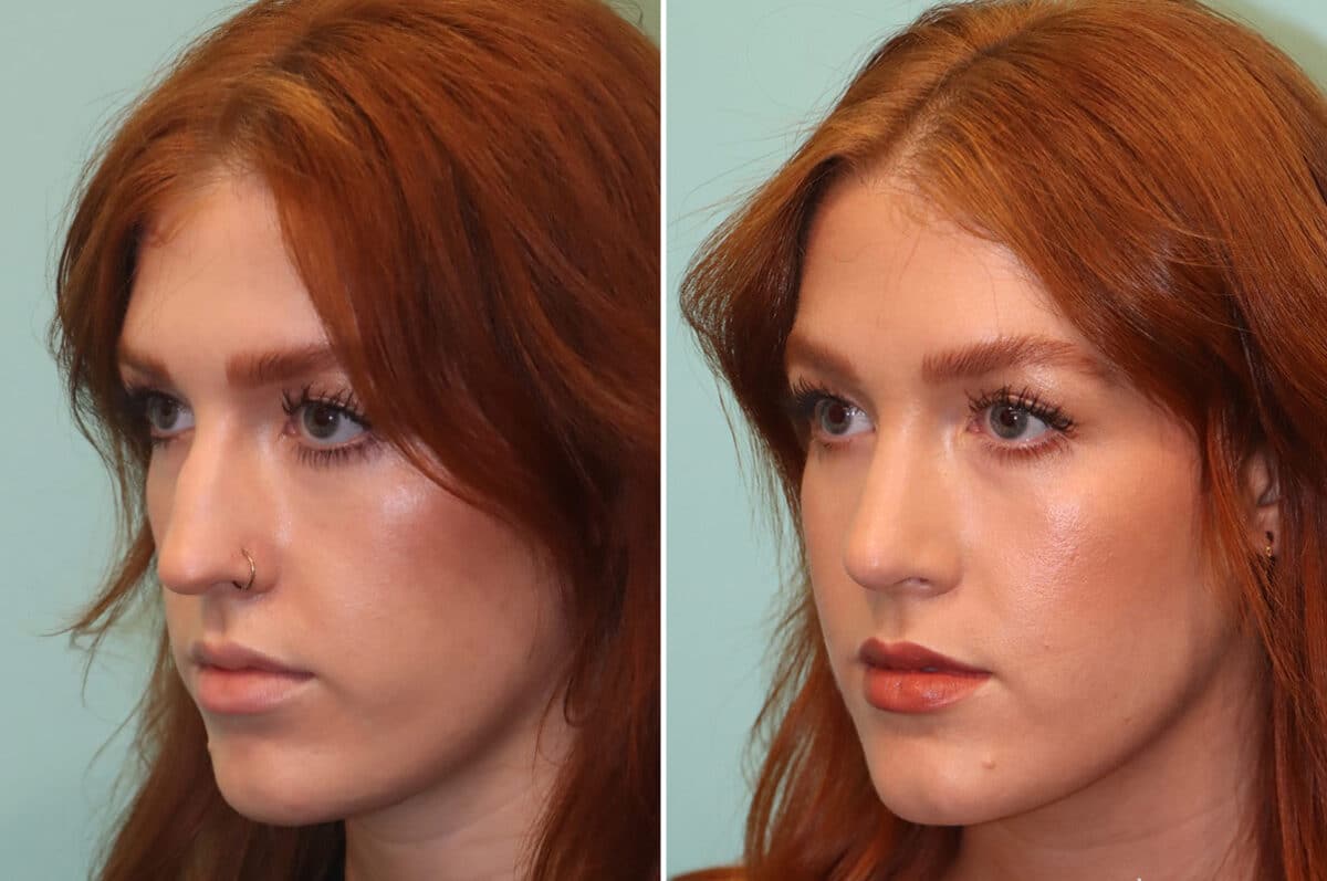 Before and after Rhinoplasty by Dr. Shervin Naderi, Patient 25190