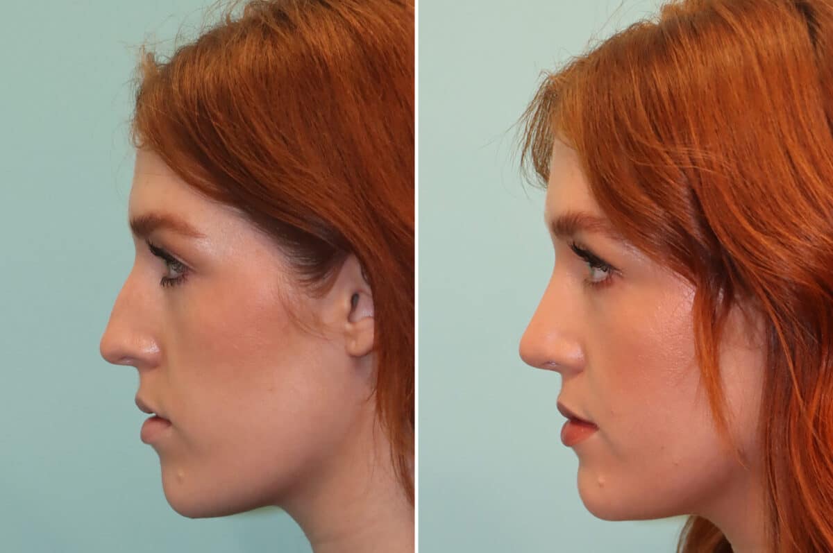 Before and after Rhinoplasty by Dr. Shervin Naderi, Patient 25190