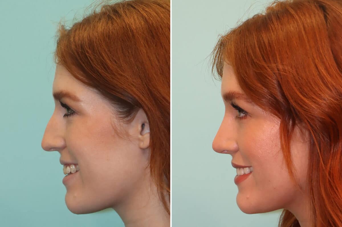 Before and after Rhinoplasty by Dr. Shervin Naderi, Patient 25190