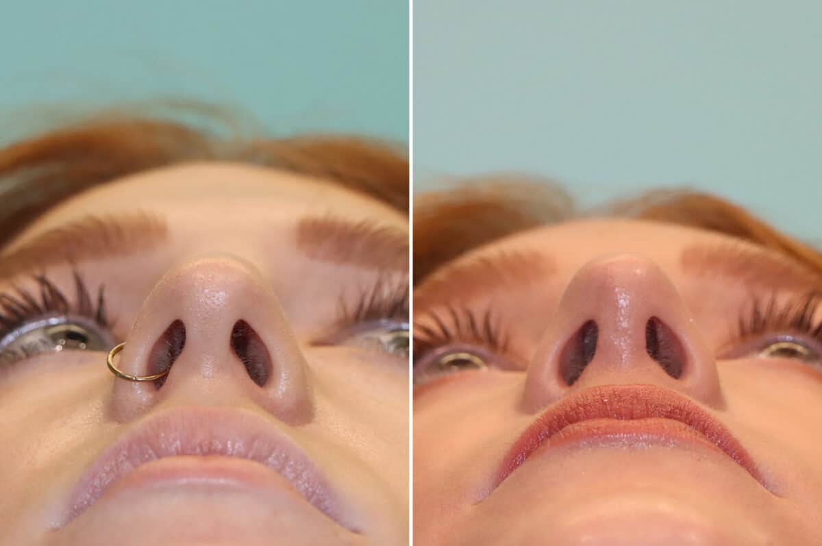 Before and after Rhinoplasty by Dr. Shervin Naderi, Patient 25190