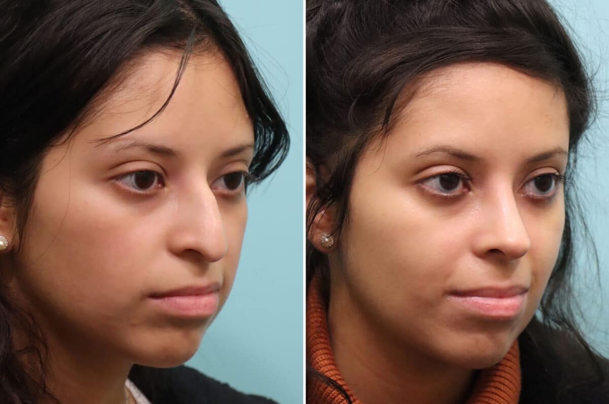 Before and after Rhinoplasty by Dr. Shervin Naderi, Patient 25212