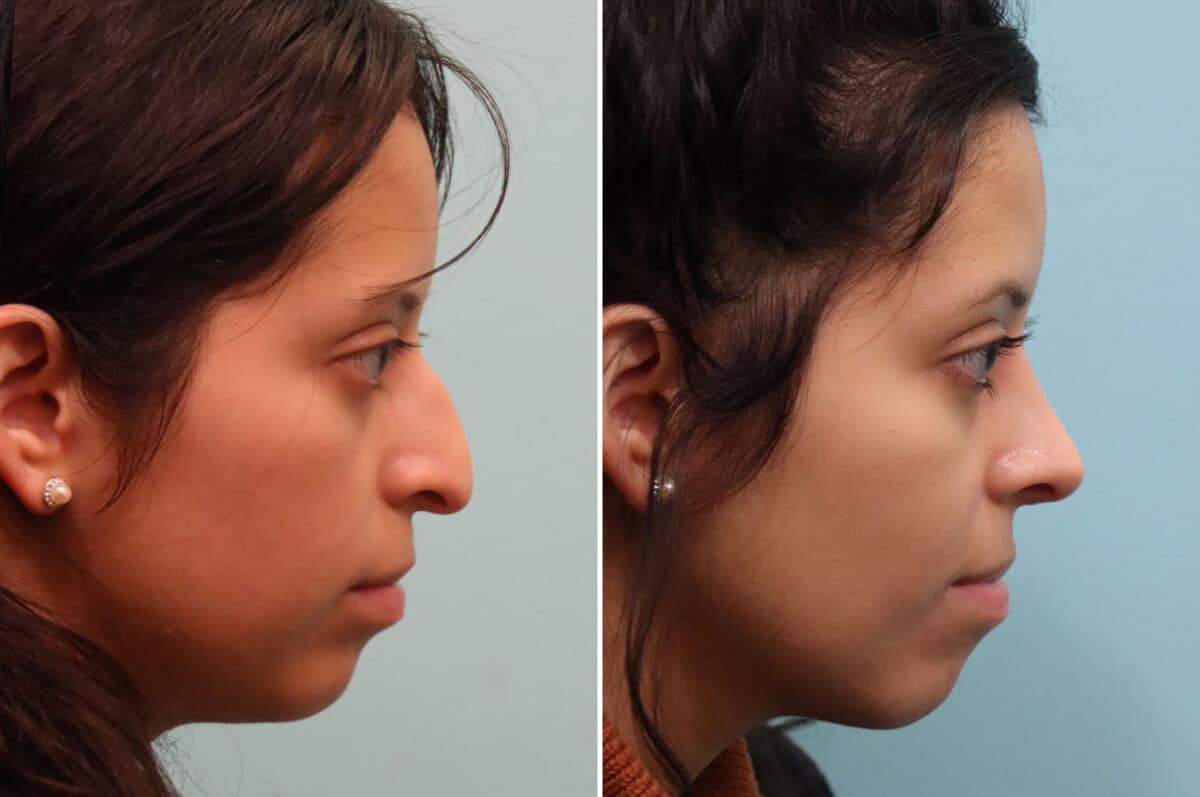 Before and after Rhinoplasty by Dr. Shervin Naderi, Patient 25212