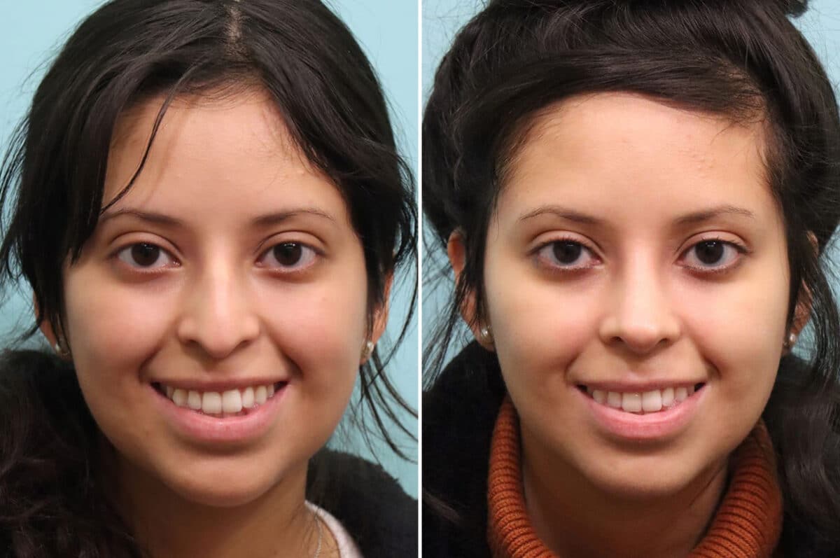 Before and after Rhinoplasty by Dr. Shervin Naderi, Patient 25212