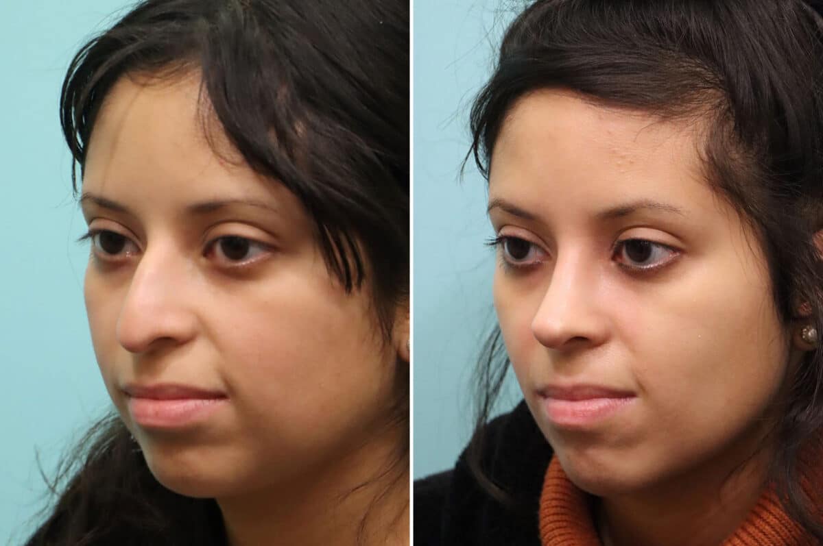 Before and after Rhinoplasty by Dr. Shervin Naderi, Patient 25212