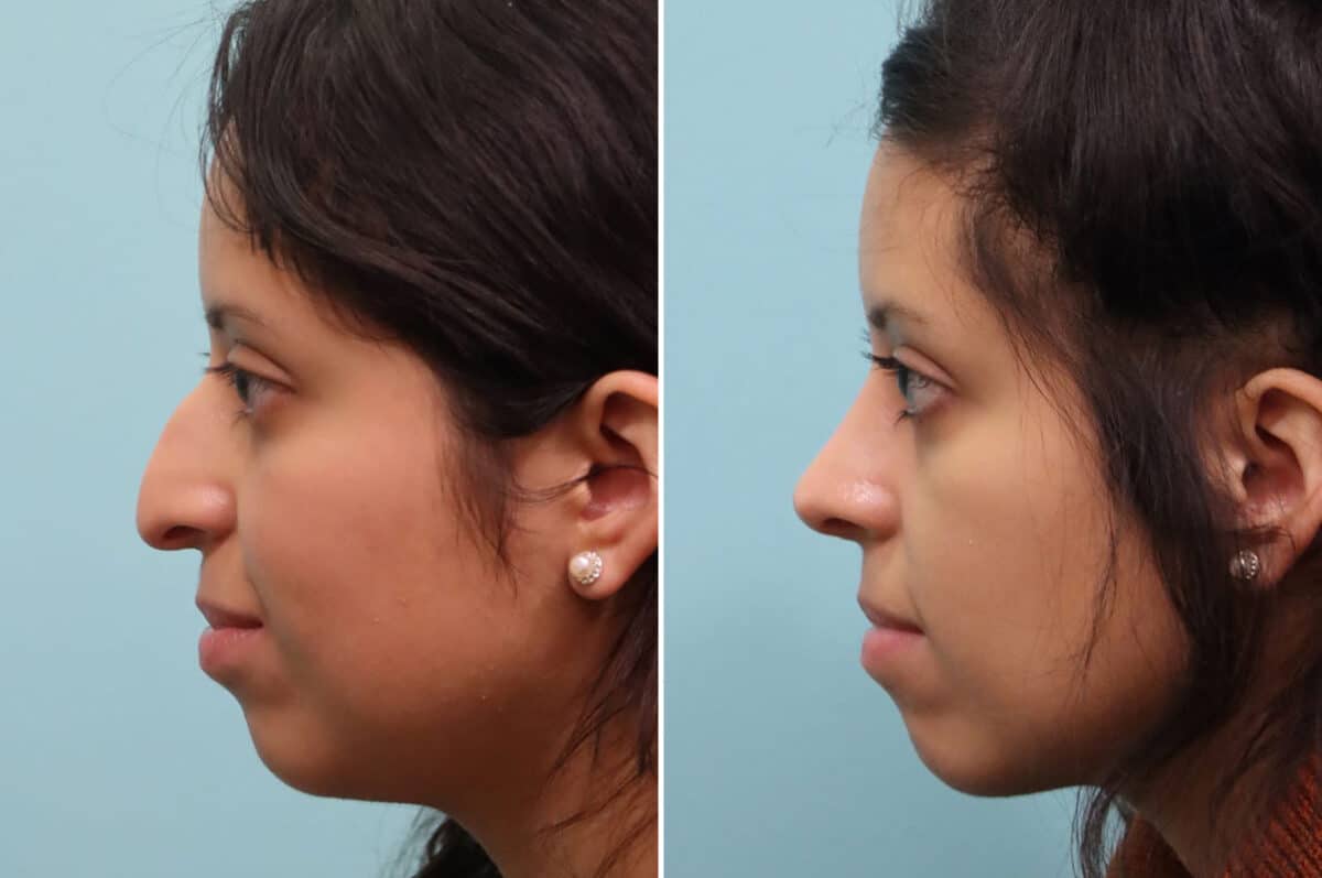 Before and after Rhinoplasty by Dr. Shervin Naderi, Patient 25212