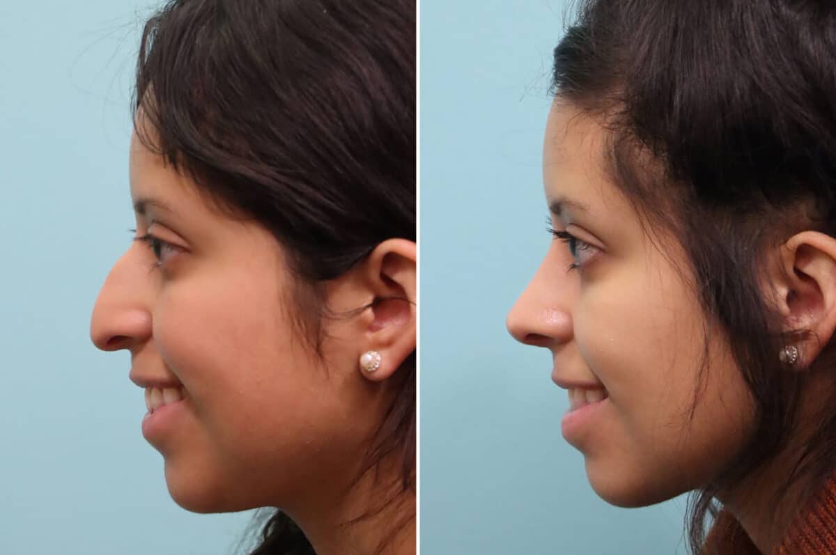 Before and after Rhinoplasty by Dr. Shervin Naderi, Patient 25212