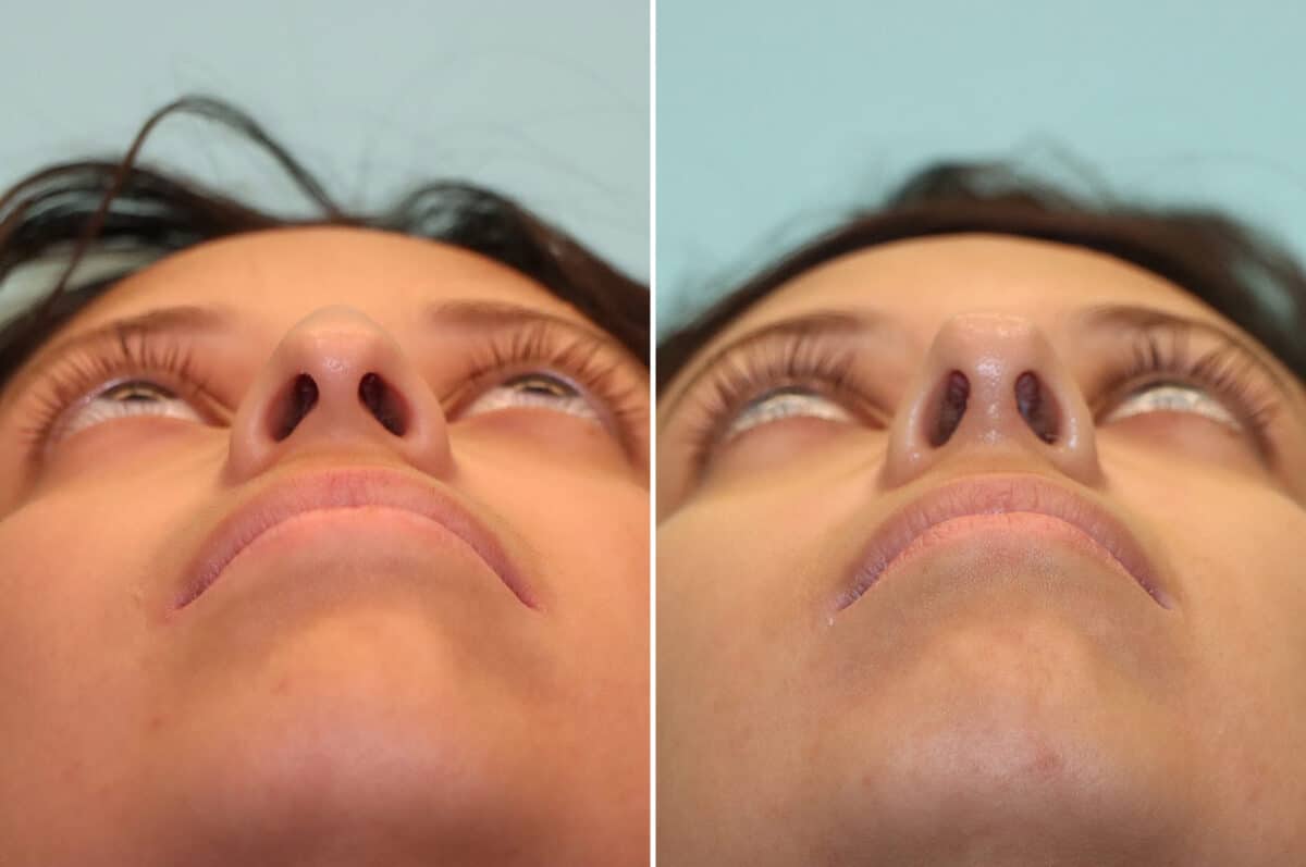 Before and after Rhinoplasty by Dr. Shervin Naderi, Patient 25212