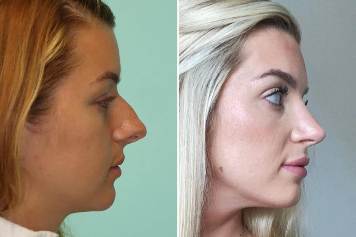 Before and after Rhinoplasty by Dr. Shervin Naderi, Patient 25237