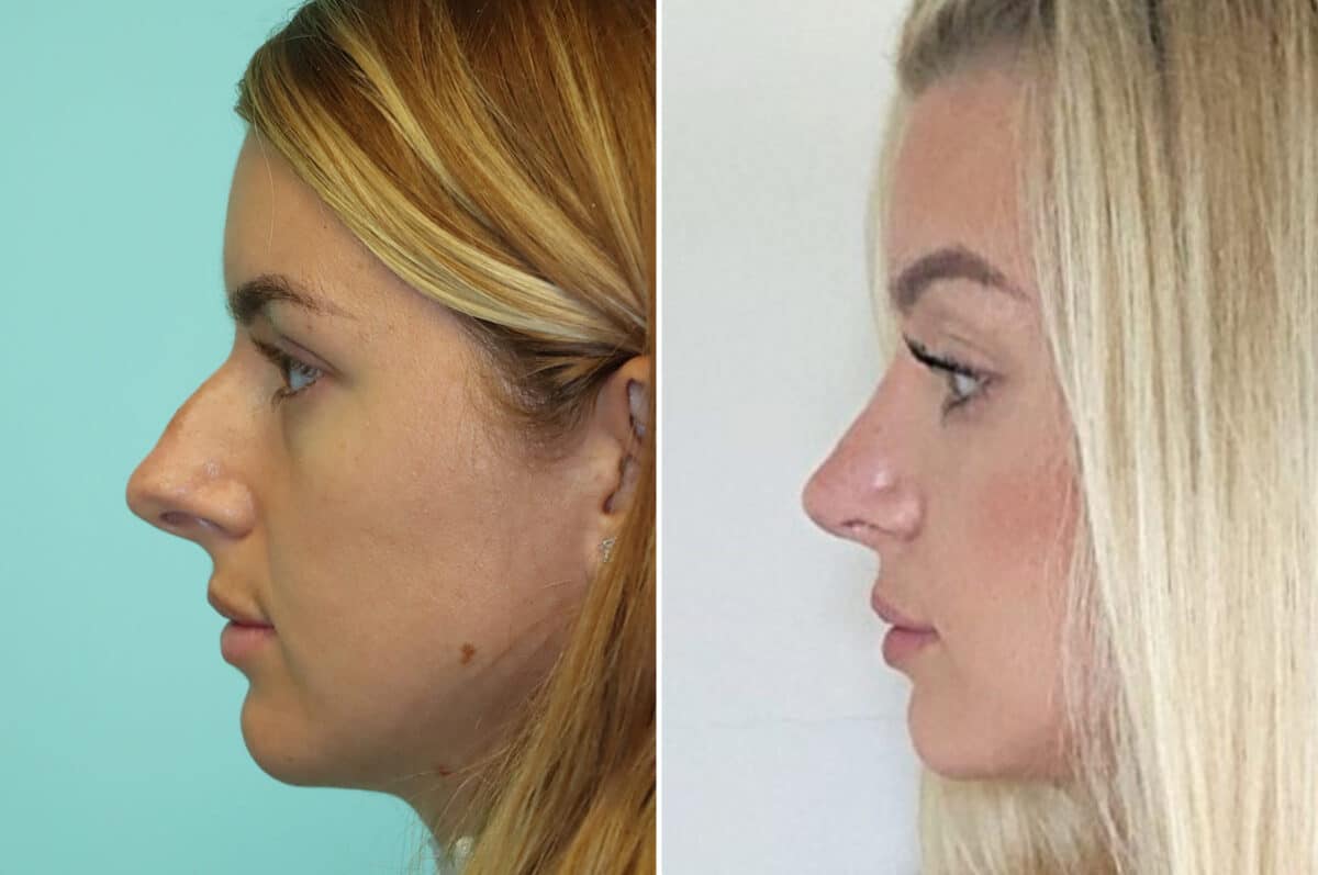 Before and after Rhinoplasty by Dr. Shervin Naderi, Patient 25237