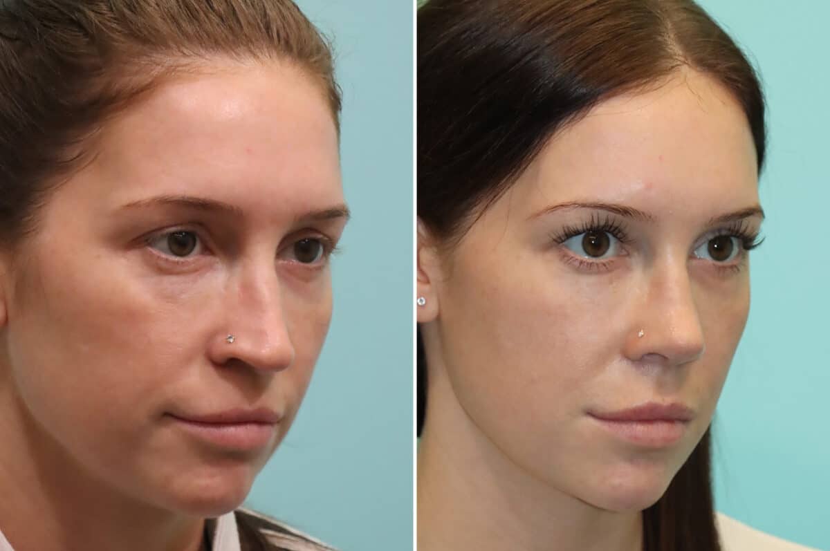 Before and after Rhinoplasty by Dr. Shervin Naderi, Patient 25244